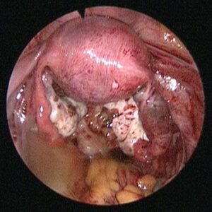 ECTOPIC-PREGNANCY
