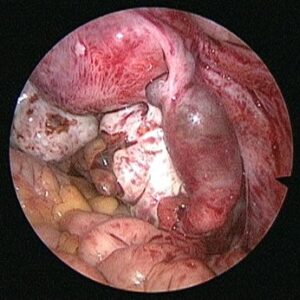 ECTOPIC-PREGNANCY1