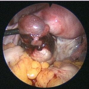 ECTOPIC-PREGNANCY2