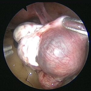 ECTOPIC-PREGNANCY3